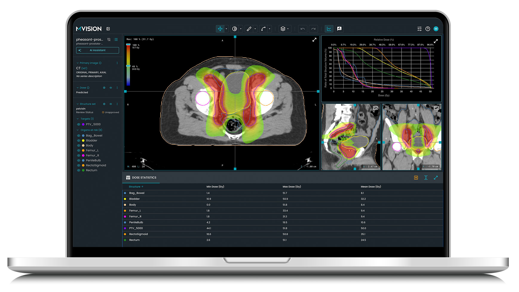 AI Powered Solutions For Radiotherapy MVision AI