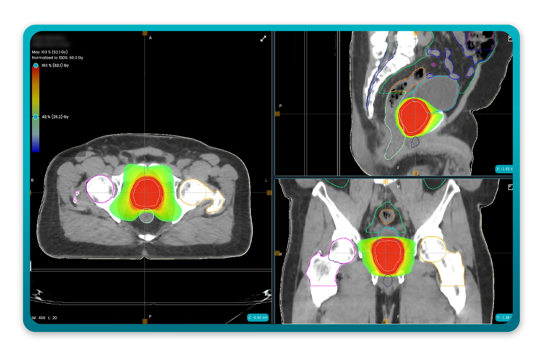 Models in Dose+: Prostate